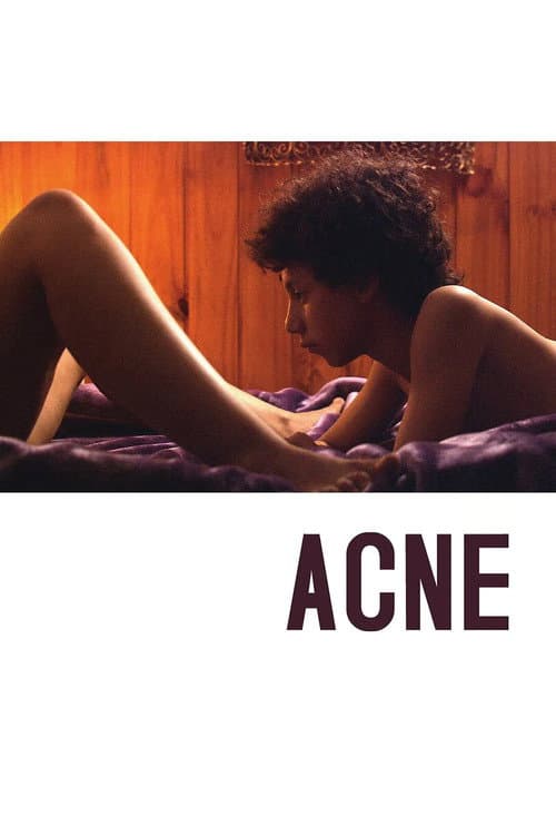 Acne poster